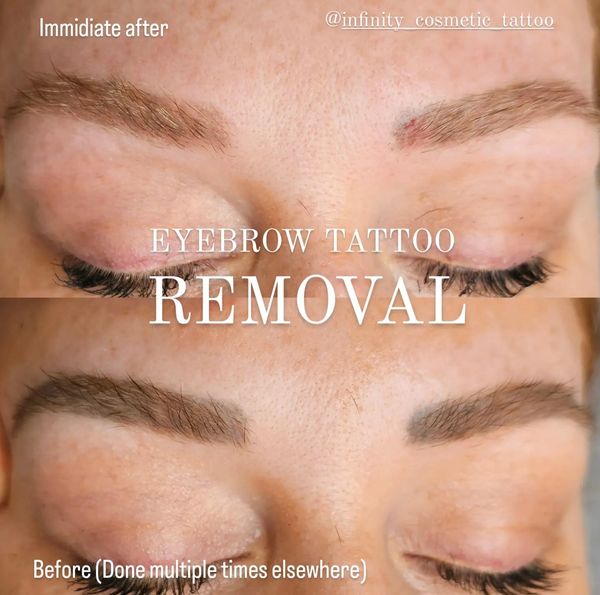 COSMETIC TATTOO REMOVAL Infinity Cosmetic Tattoo
